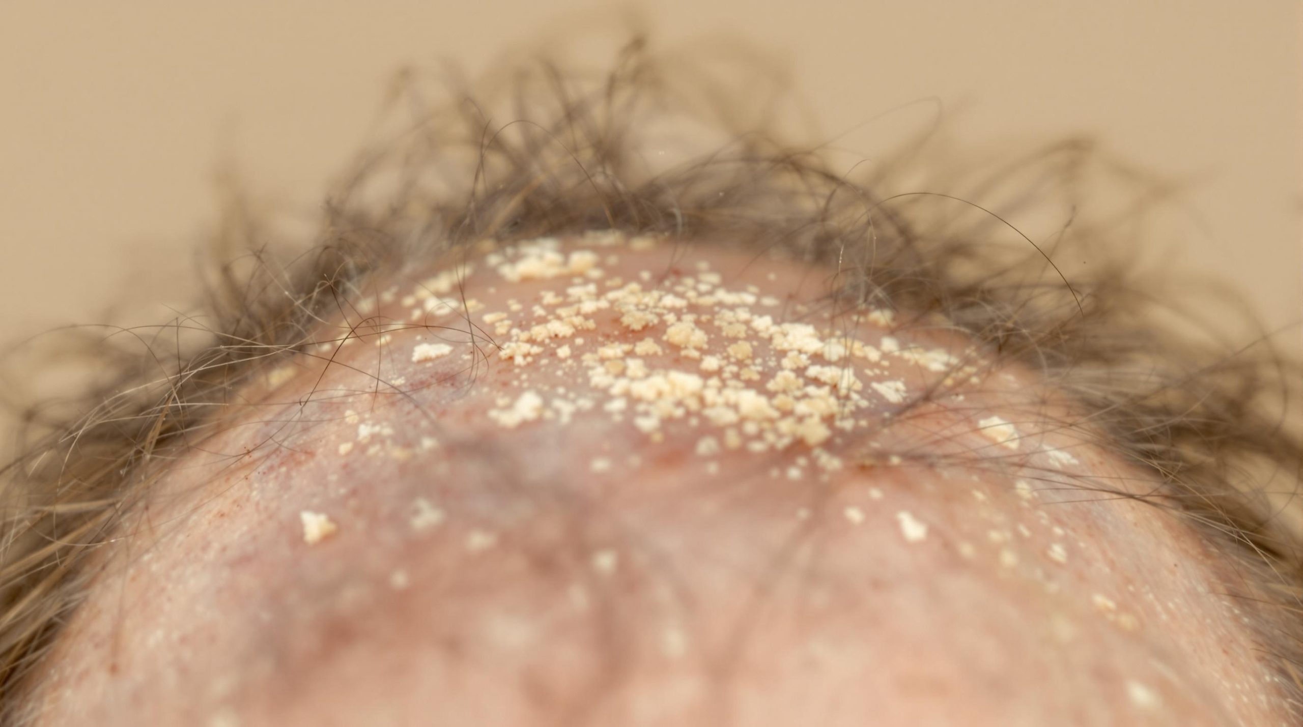 Cuir chevelu qui gratte et pellicules : causes et solutions - Beaute Serenite